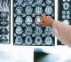 Brain injury compensation