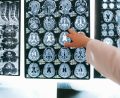 Effects of Brain Injuries