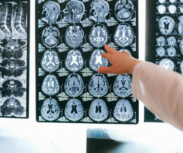 Effects of Brain Injuries
