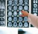 Effects of Brain Injuries