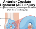 ACL Tear Injury