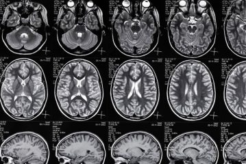 brain injury lawyer in Austin