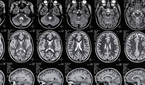 brain injury lawyer in Austin