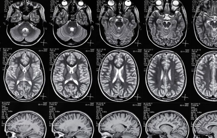 brain injury lawyer in Austin