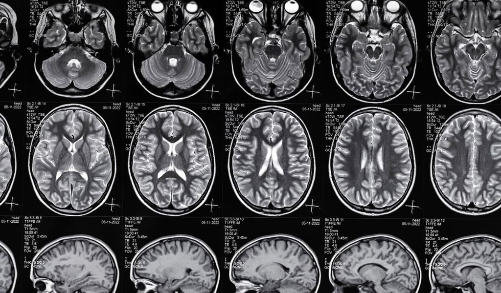 brain injury lawyer in Austin